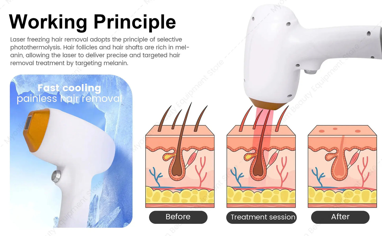 Diode Laser Hair Removal Machine | 808Nm Wavelength | Ice Cooling Head