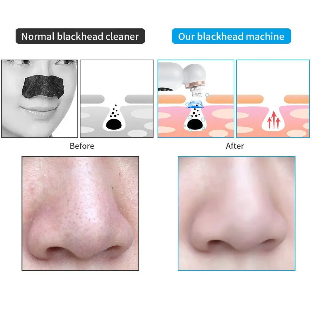New Blackhead Remover Vacuum Suction Personal Care Small Bubble Electric Face Nose Cleaner from PriceLows™