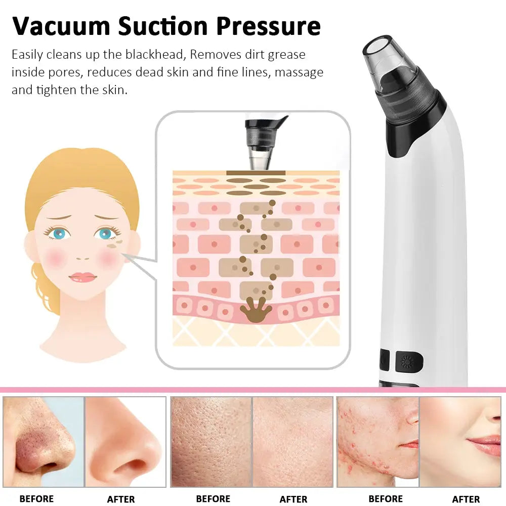 Facial Blackhead Remover Electric Hot Compress Vacuum Pore Cleaner Face Deep Nose Cleaner T Zone Pore Acne Pimple Removal Tool from PriceLows™