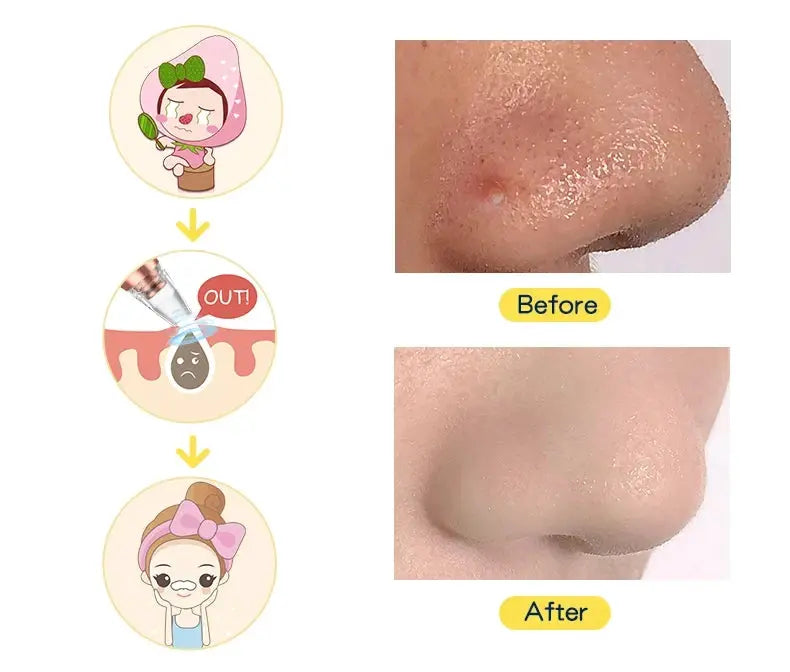 Blackhead Remover Pore Vacuum Electric Comedone Acne Extractor Kit Facial Pore Deep Cleaner USB Rechargeable Skin Care Tools from PriceLows™