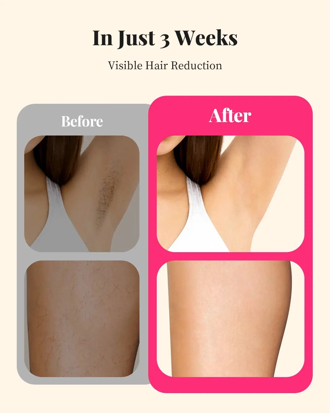 Totmizby IPL Hair Removal | 990,000 Flashes | Body and Face | Painless Permanent