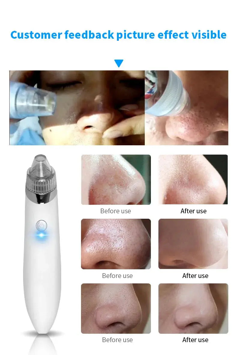 Blackhead remover beauty instrument electric cleanser facial pore cleaner blackhead remover from PriceLows™